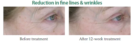 reduction-in-fine-lines-and-wrinkles