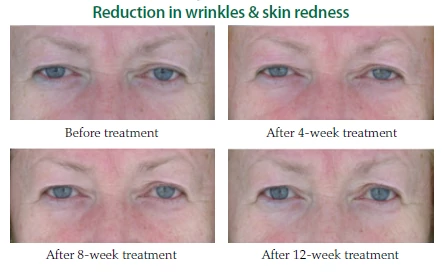 reduction-in-wrinkle-and-skin-redness